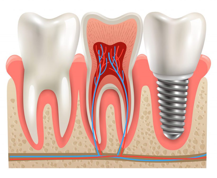 Implantologie orale