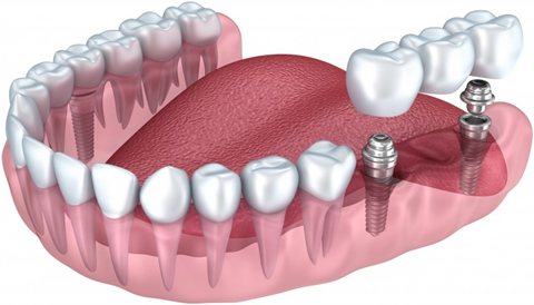 Prothèse sur implant (remplace un groupe de dents)